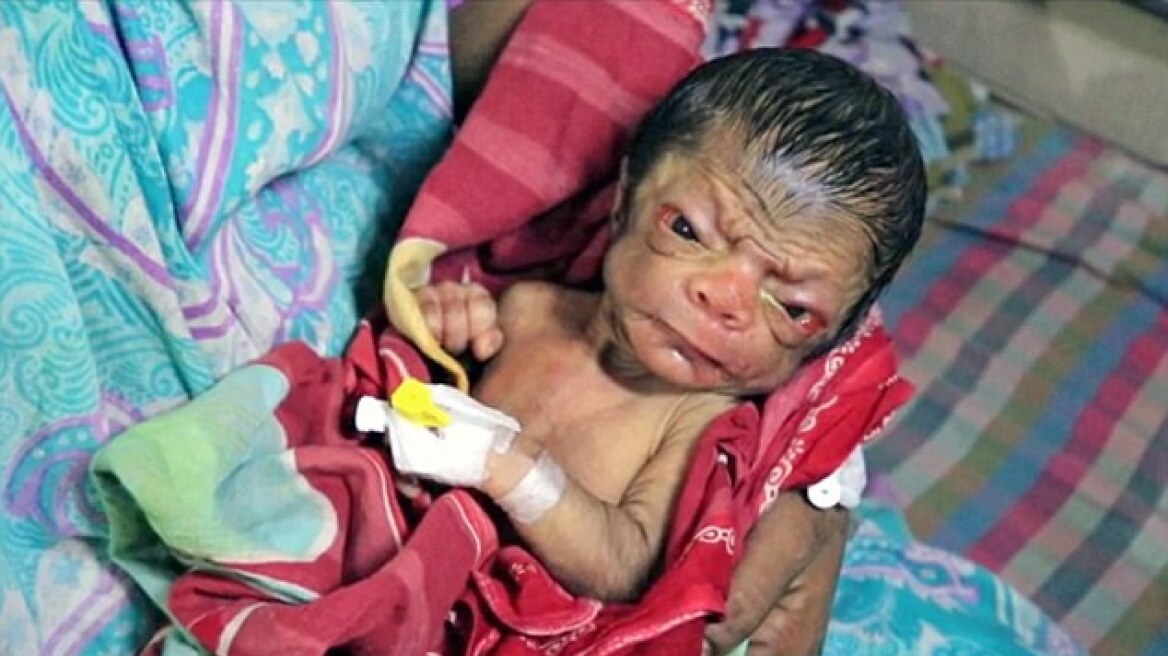 Το μωρό «Μπέντζαμιν Μπάτον»: Είναι νεογέννητο αλλά μοιάζει 80 ετών