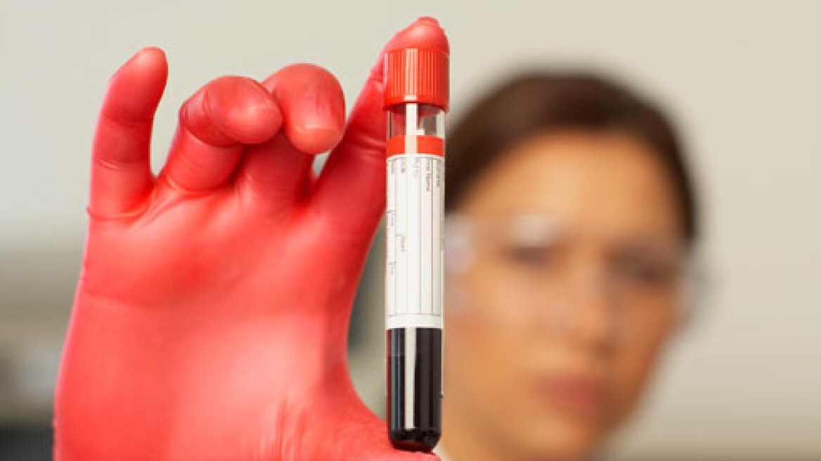 Τεστ αίματος ανιχνεύει την οστεοαρθρίτιδα χρόνια πριν τα πρώτα συμπτώματα