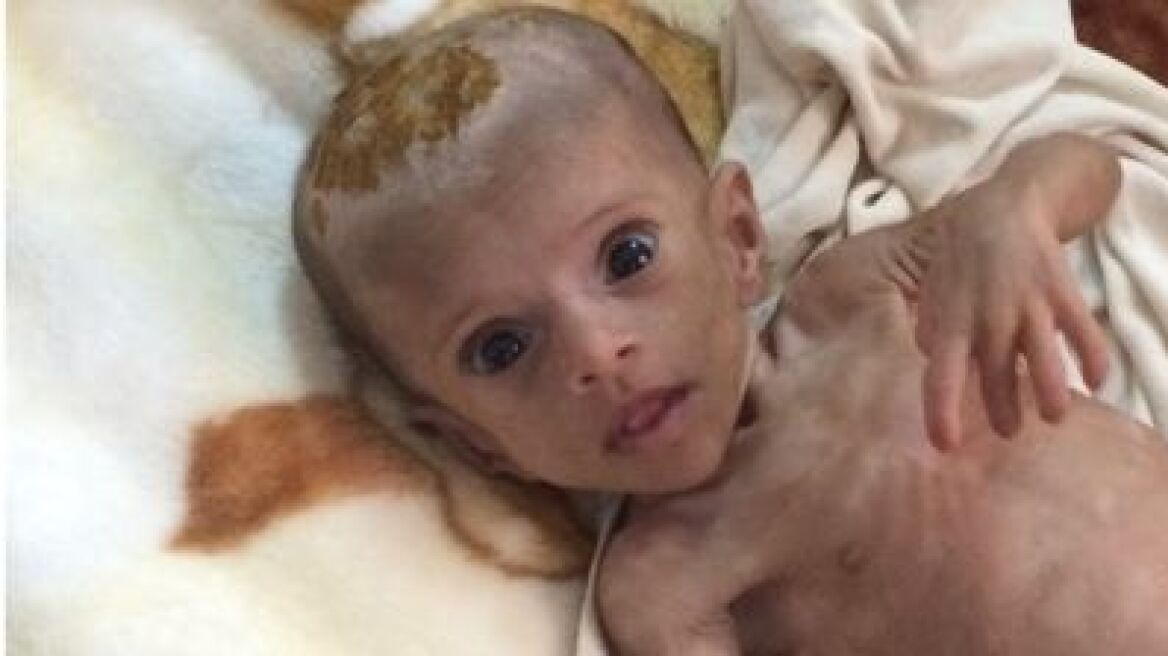 Υεμένη: Τα παιδιά πεθαίνουν από την πείνα και ο κόσμος κάνει τα στραβά μάτια