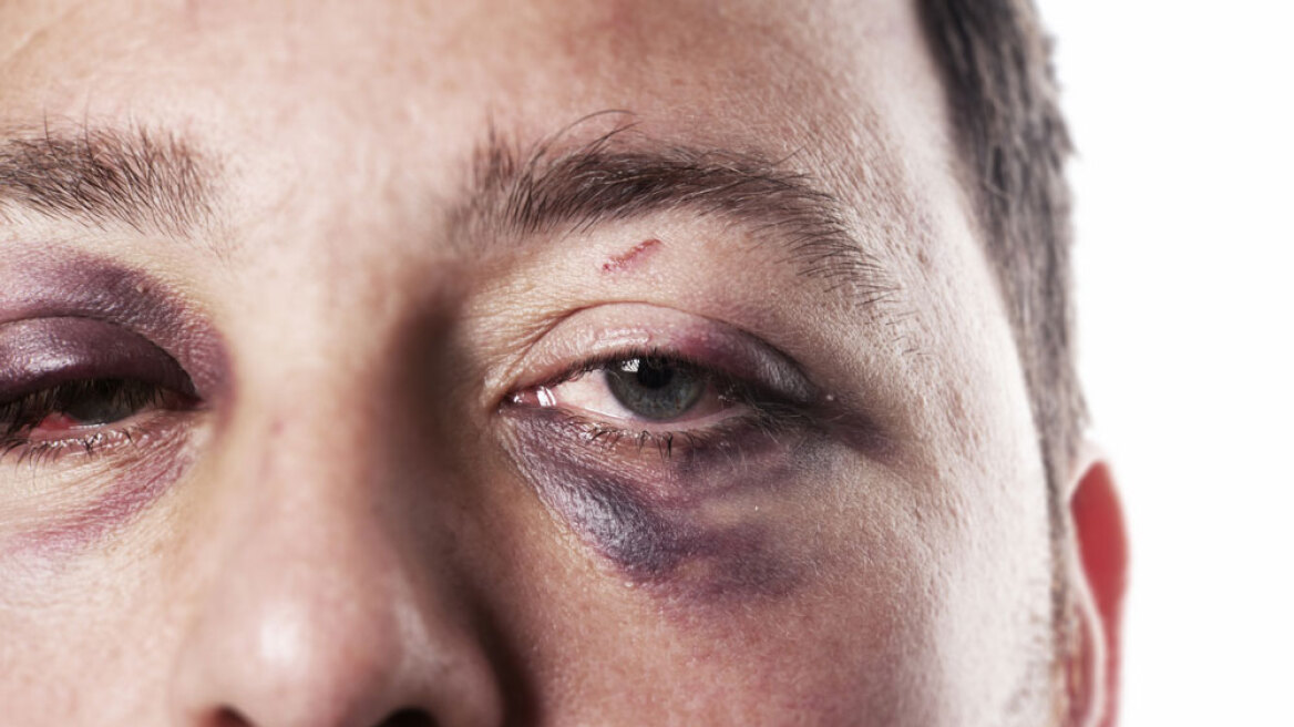 Άντρας είναι ένα στα τρία θύματα ενδοοικογενειακής βίας στην Αγγλία