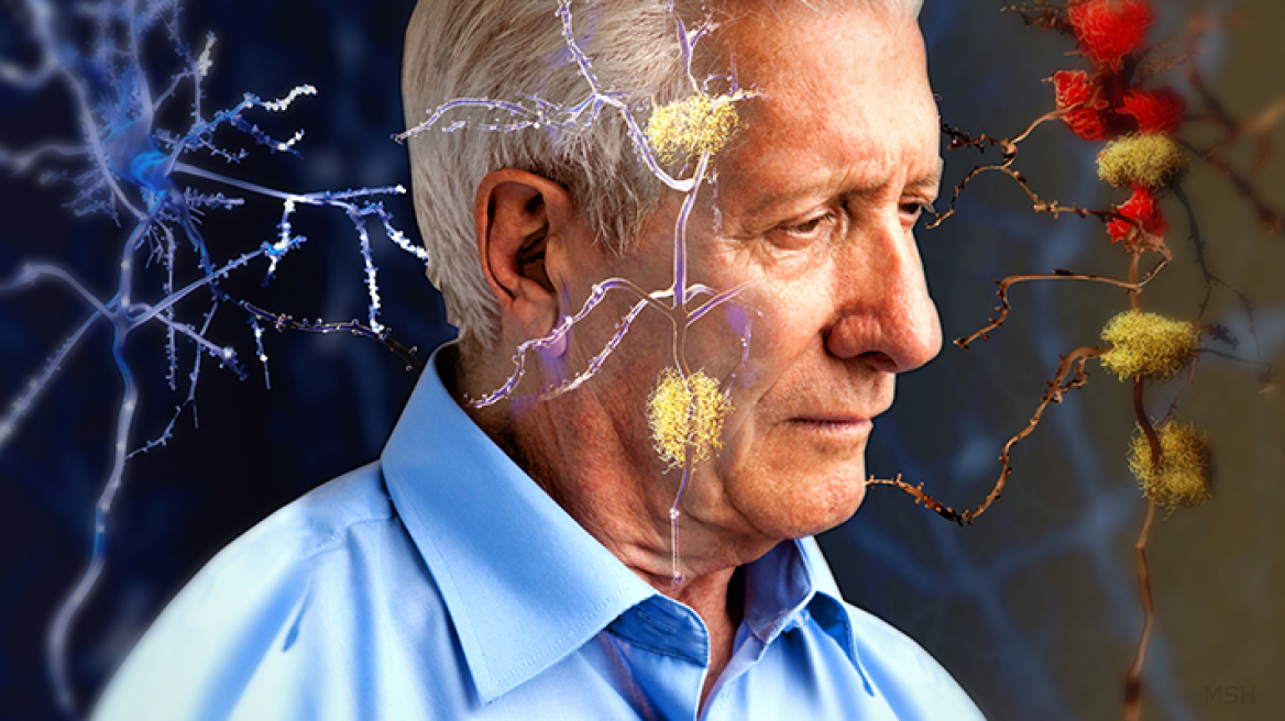 Η ανακάλυψη μιας νέας ασθένειας ίσως βοηθήσει στην θεραπεία των νόσων Αλτσχάιμερ και Πάρκινσον