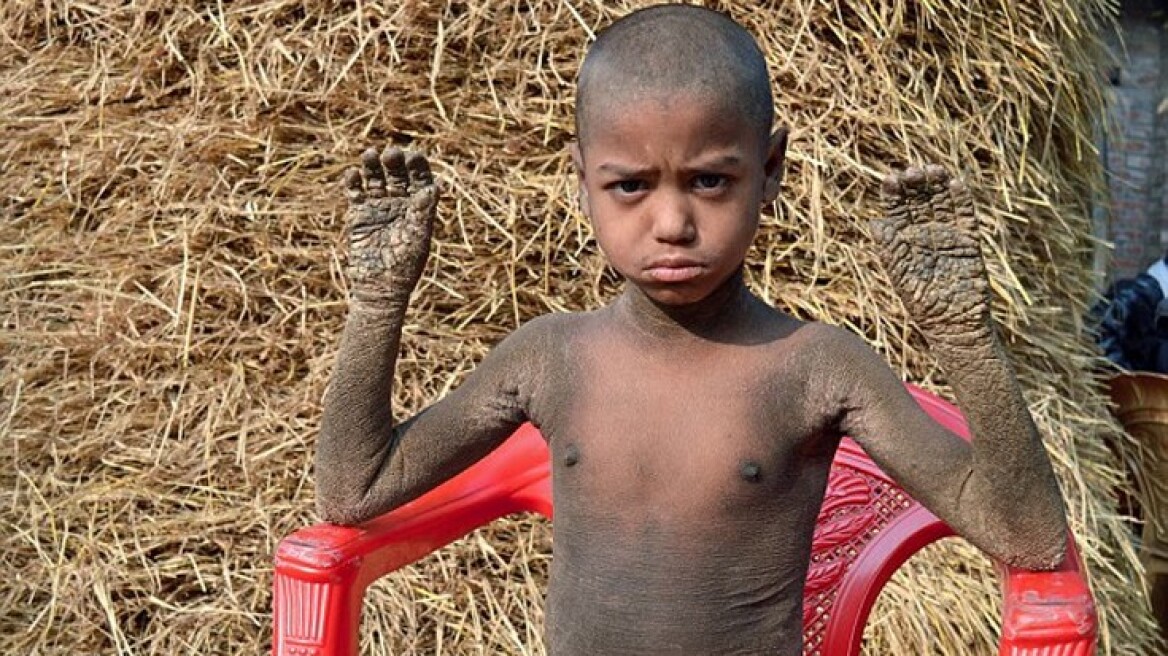 Φωτογραφίες: Δείτε το αγόρι από το Μπαγκλαντές που μετατρέπεται σε πέτρα