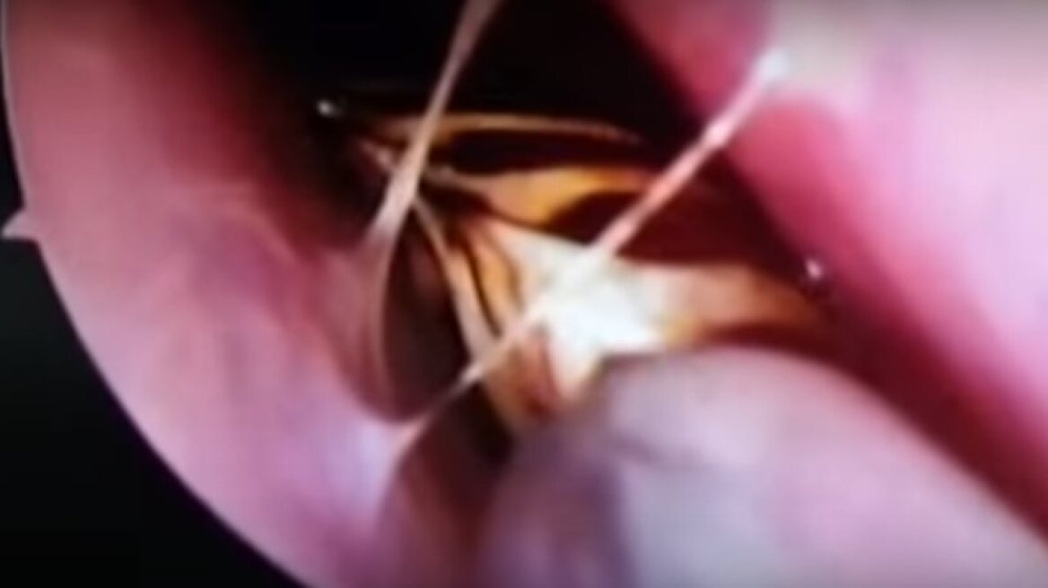  She had a cockroach inside her skull! (VIDEO)
