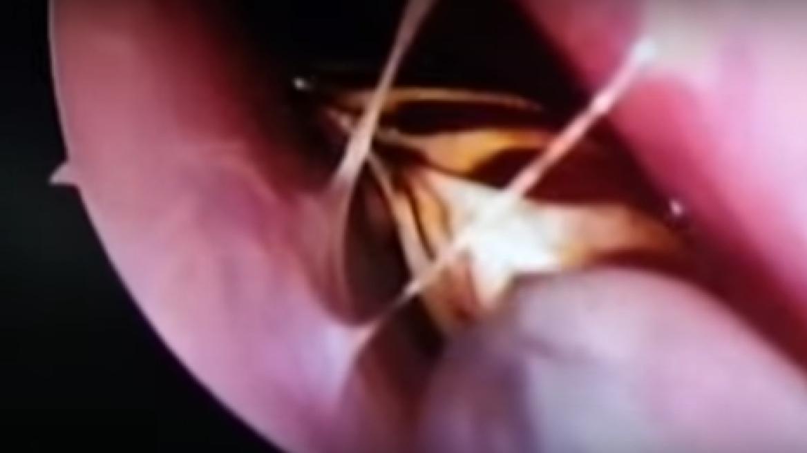 Βίντεο: Βρέθηκε ζωντανή κατσαρίδα μέσα στο κρανίο 42χρονης