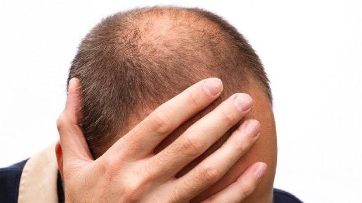 Έρευνα: Οι κοντοί άντρες έχουν περισσότερες πιθανότητες να χάσουν τα μαλλιά τους