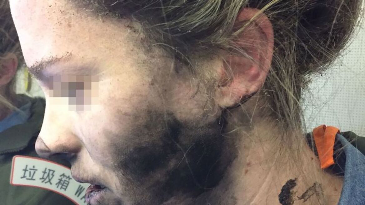 Τρομερές εικόνες: Εξερράγησαν τα ακουστικά που είχε στα αυτιά της εν μέσω πτήσης
