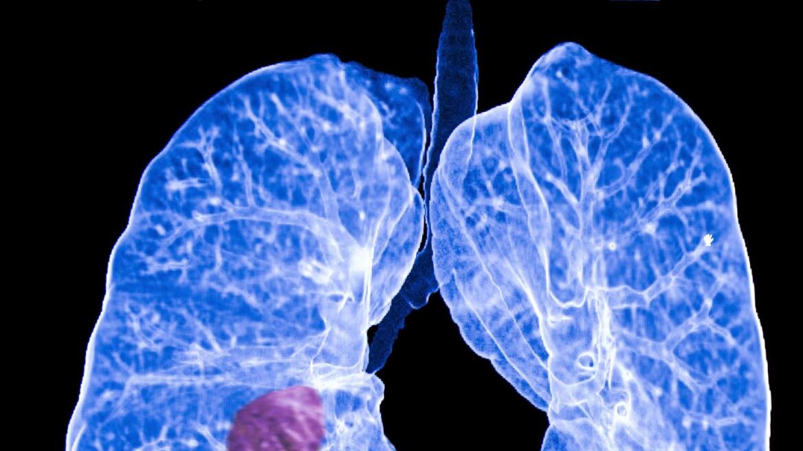 Aπό όλους τους καρκίνους αυτός του πνεύμονα αυξάνει τον κίνδυνο αυτοκτονίας του ασθενούς