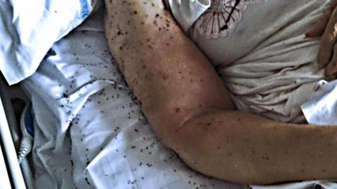 Ηλικιωμένη γυναίκα εγκαταλείφθηκε σε κλίνη νοσοκομείου της Νάπολης, γεμάτη μυρμήγκια