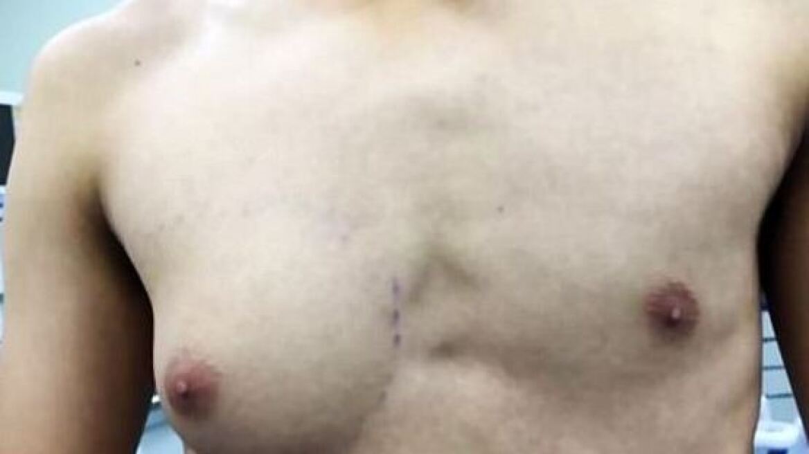 Φωτογραφία: Έφηβος απέκτησε... γυναικείο στήθος λόγω της διατροφής του!