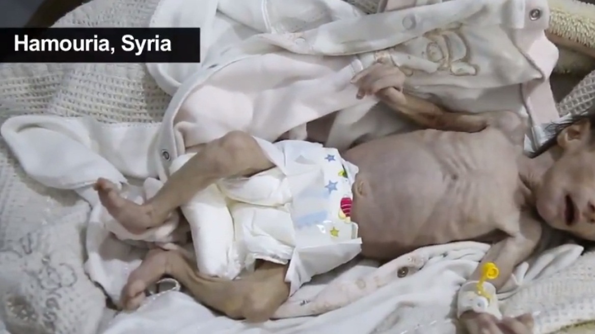 Πολύ σκληρές εικόνες: Μωρό ενός μηνός πεθαίνει από την πείνα στη Συρία 