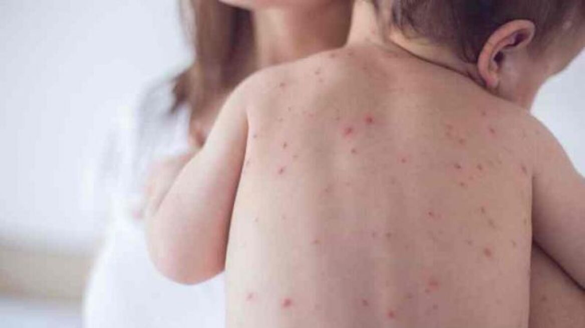 Ένα βρέφος 11 μηνών το πρώτο θύμα της ιλαράς