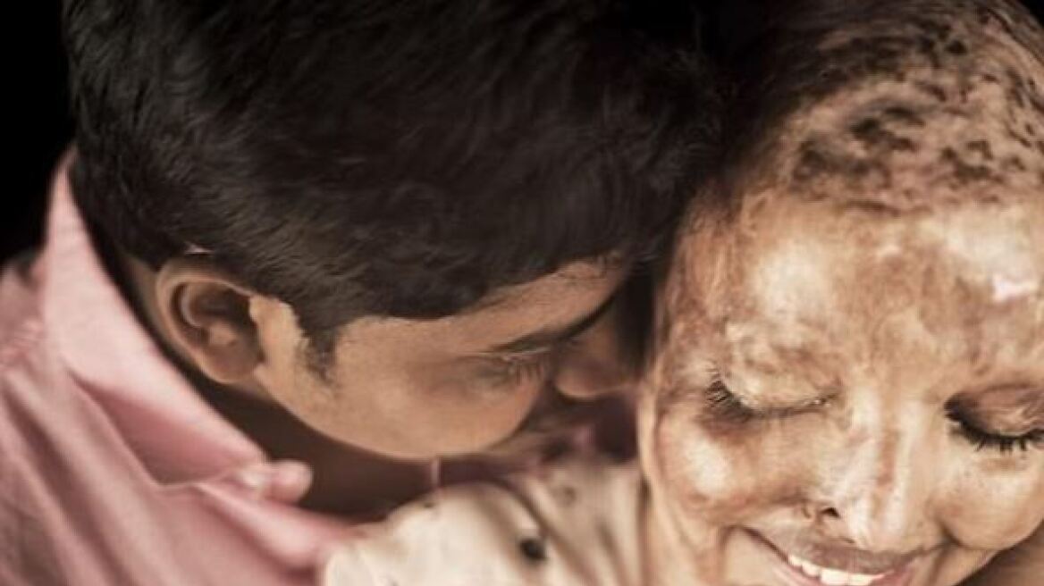«Μ' αγαπάει όπως είμαι»: Τυφλώθηκε σε επίθεση με οξύ, βρήκε τον έρωτα της ζωής της στο νοσοκομείο