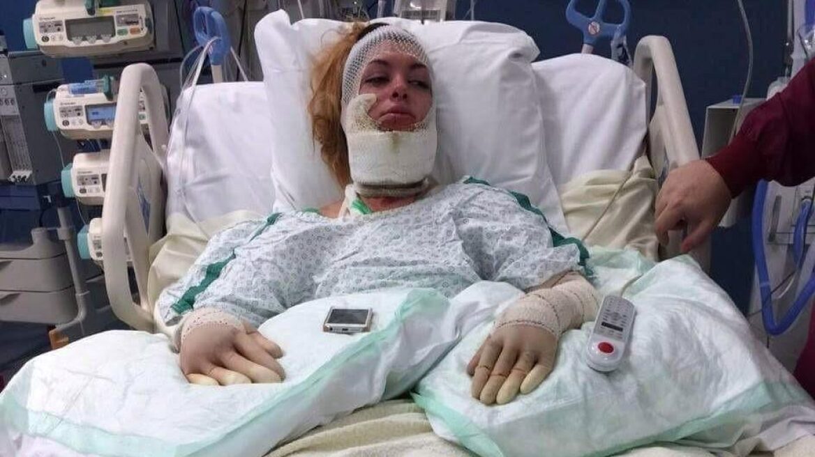Βέλγιο: 25χρονη άνοιξε το καπάκι της κατσαρόλας και... κόντεψε να καεί ζωντανή!