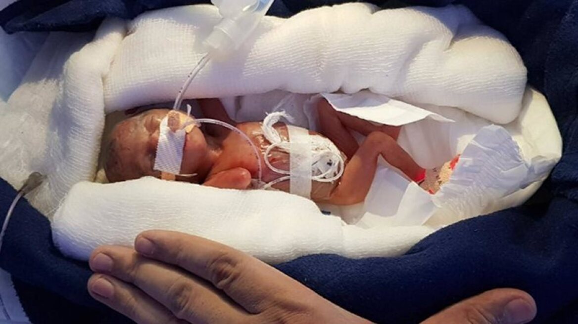 Incredible! 400-gram baby survives! (photos)