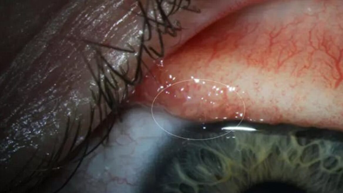 Πρωτοφανές περιστατικό: Αφαίρεσαν 19 σκουλήκια από το μάτι μιας 26χρονης!