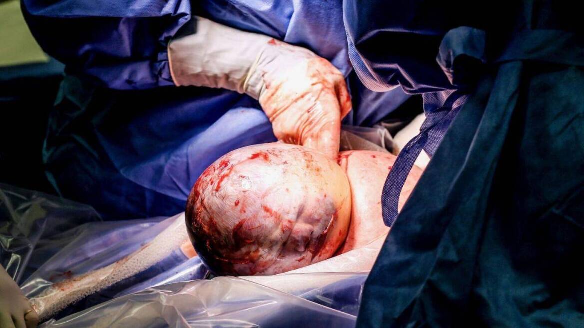 Απίστευτες εικόνες: Σπάνια γέννηση μωρού με το κεφάλι στον αμνιακό σάκο