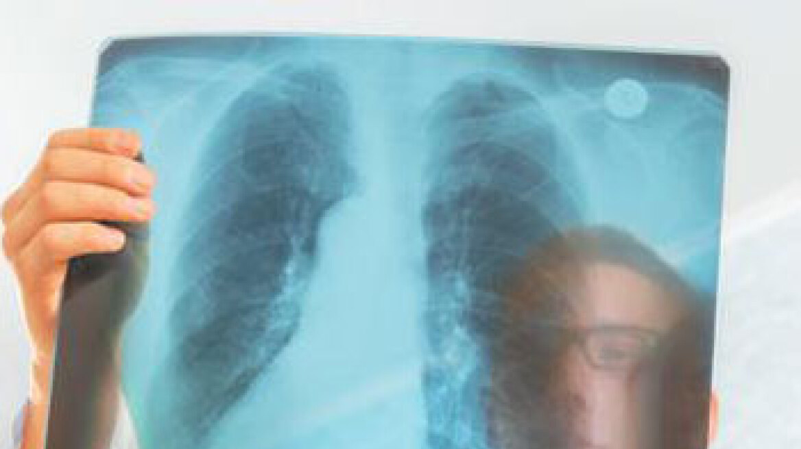 Παγκόσμια Ημέρα Φυματίωσης: «Καλπάζει» η νόσος στην Ελλάδα