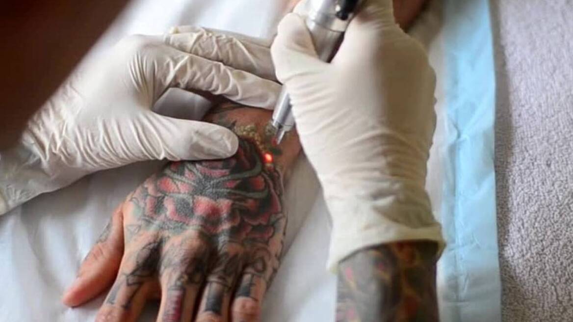 tattoo-removal-