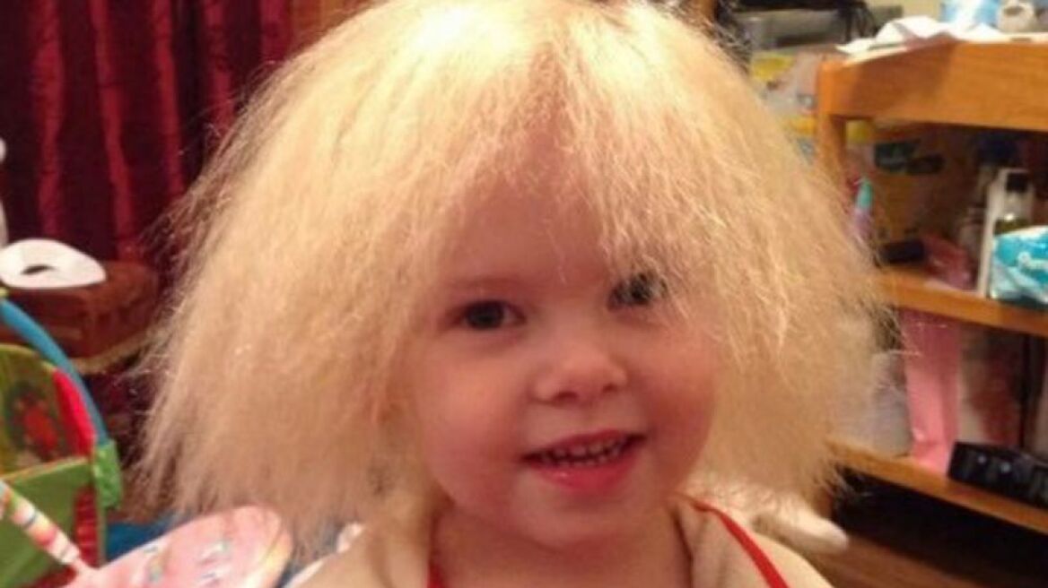 0_PAY-GIRL-HAS-UNCOMBABLE-HAIR-SYNDROME