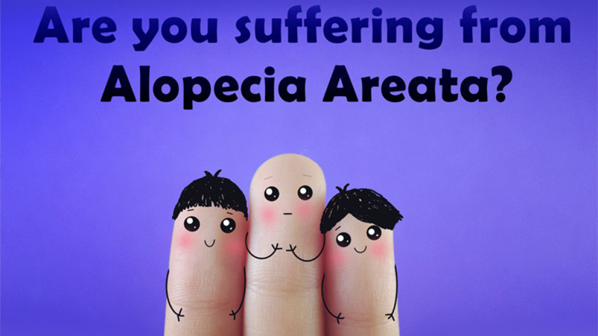 alopecia
