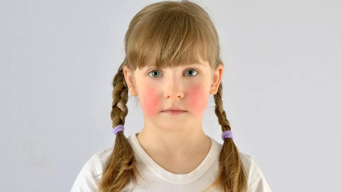 child-with-red-cheeks_1283653012