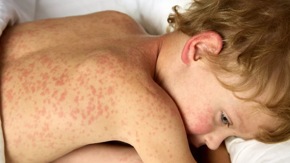 measles_child_2286749737