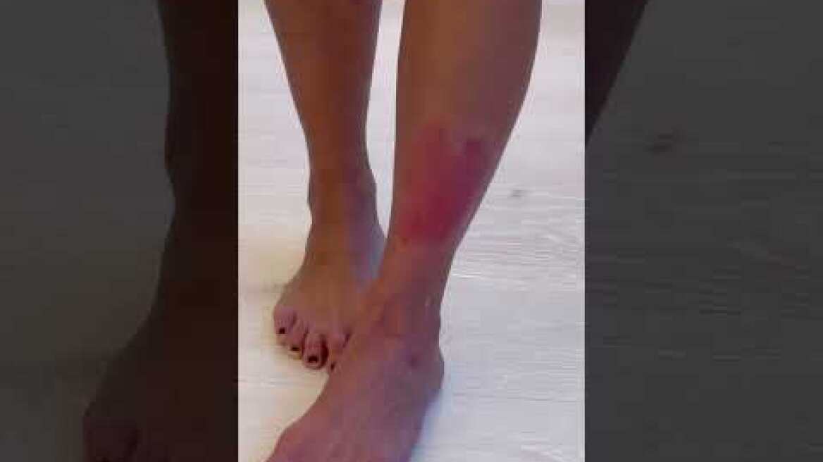 Kim Kardashian shfaq publikisht psoriasis në këmbë - është shumë e dhimbshme, thotë ajo