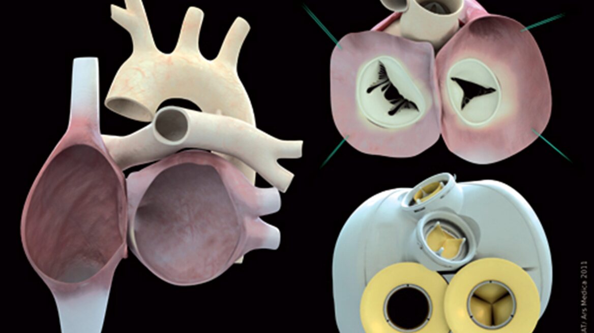 Αυτή είναι η καρδιά που δίνει ελπίδα σε χιλιάδες ασθενείς
