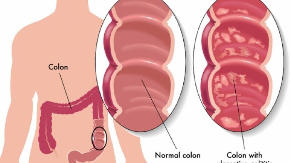 Η νόσος Crohn και η ελκώδης κολίτιδα δεν είναι ταμπού 