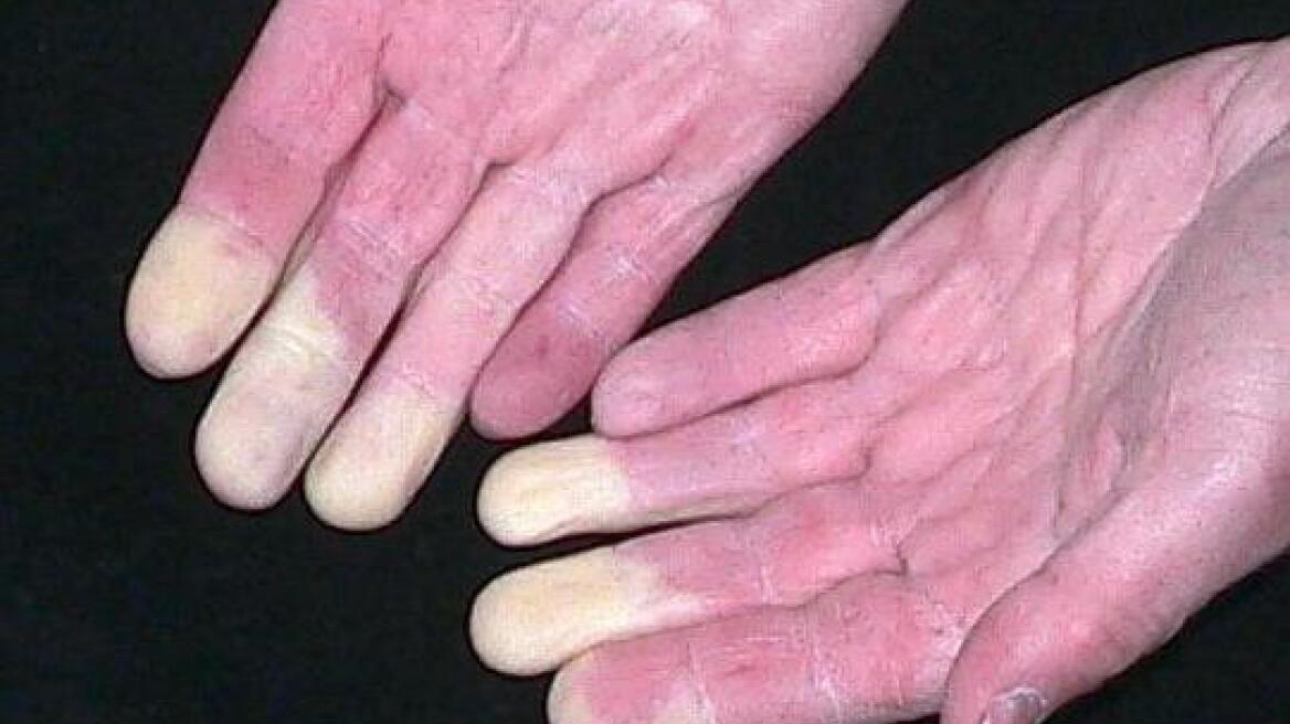 Τι είναι το φαινόμενο Raynaud και πώς επηρεάζει την υγεία μας