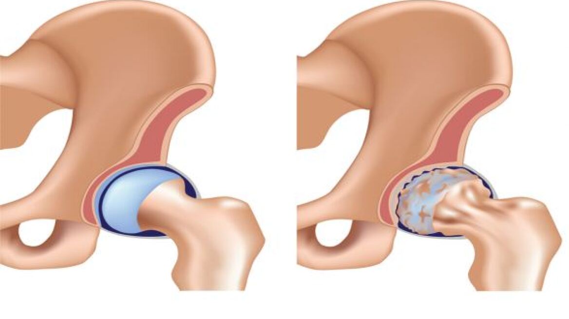 Πρωτοποριακή τεχνική (επαν)επέμβασης αρθροπλαστικής στο ισχίο