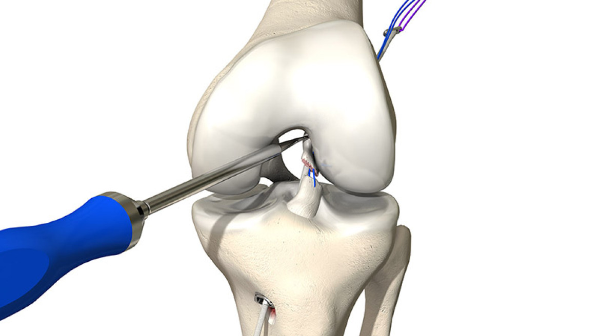 Σύστημα DIS-LIGAMYS για την αντιμετώπιση τραυματισμών του πρόσθιου χιαστού συνδέσμου στο νοσοκομείο METROPOLITAN