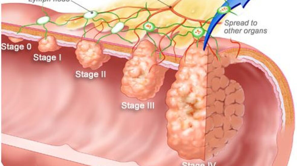 Πάνω από 5.000 Έλληνες εκδηλώνουν κάθε χρόνο καρκίνο του παχέως εντέρου