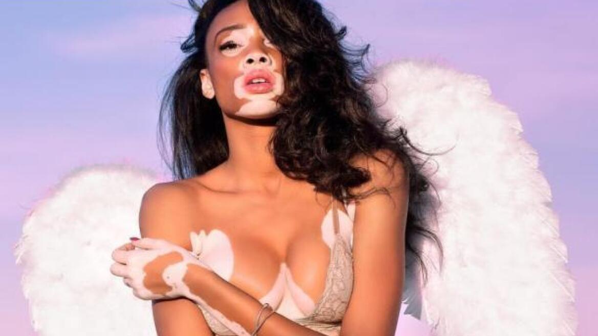 Winnie Harlow: Το μοντέλο με τη λεύκη είναι ο νέος άγγελος της Victoria's Secret