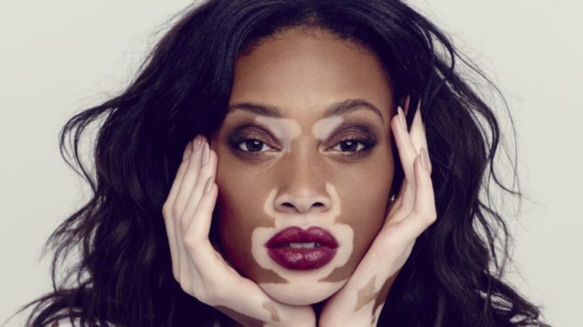 Winnie Harlow: Το μοντέλο με τη λεύκη και το απίστευτο κορμί!