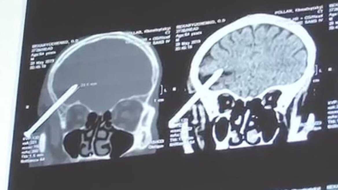Ουκρανός κάρφωσε δύο καρφιά στο κεφάλι του για να αυτοκτονήσει αλλά επέζησε!
