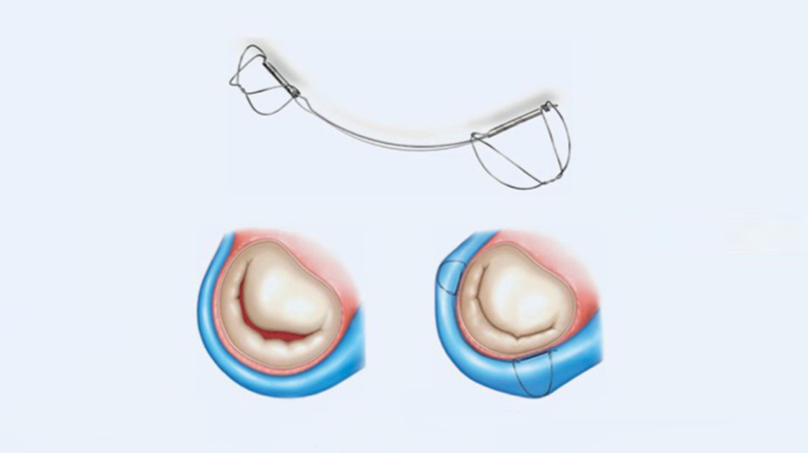 Metropolitan Hospital: Πρωτοποριακή διαδερμική μέθοδος επιδιόρθωσης ανεπάρκειας μιτροειδούς βαλβίδας