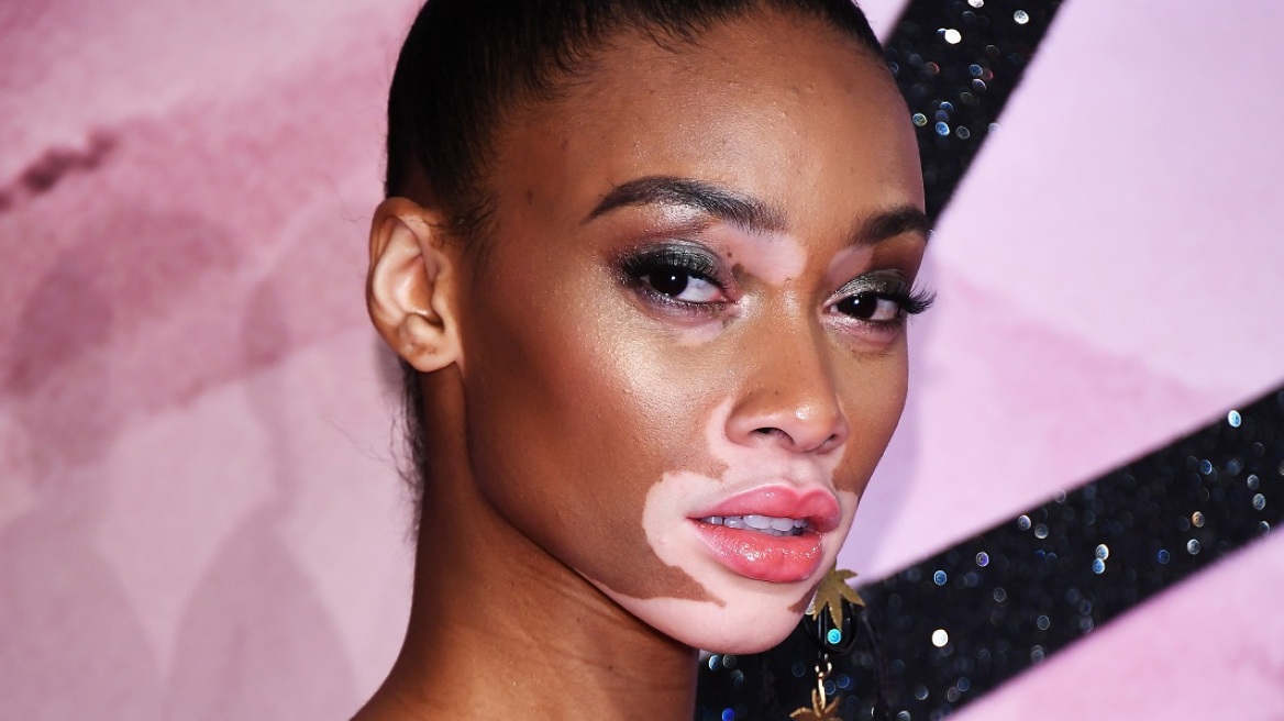 Winnie Harlow: Φωτογραφίζεται με σέξι διάθεση για τα 26α γενέθλιά της