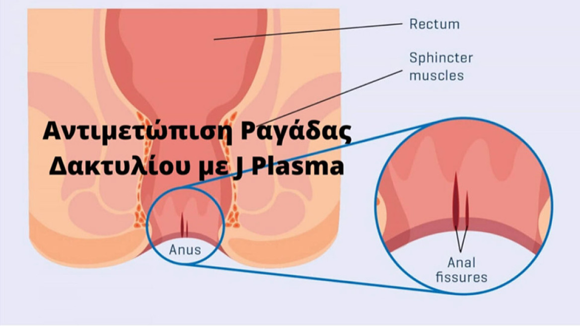 Ραγάδα πρωκτικού δακτυλίου: οριστική λύση χωρίς επώδυνες επιπλοκές  με τη μέθοδο j-plasma