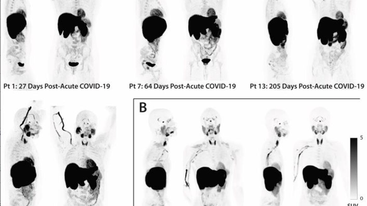 Οι ασθενείς με Long Covid μπορεί να εμφανίζουν σημάδια μη φυσιολογικής ενεργοποίησης των ανοσοποιητικών κυττάρων 