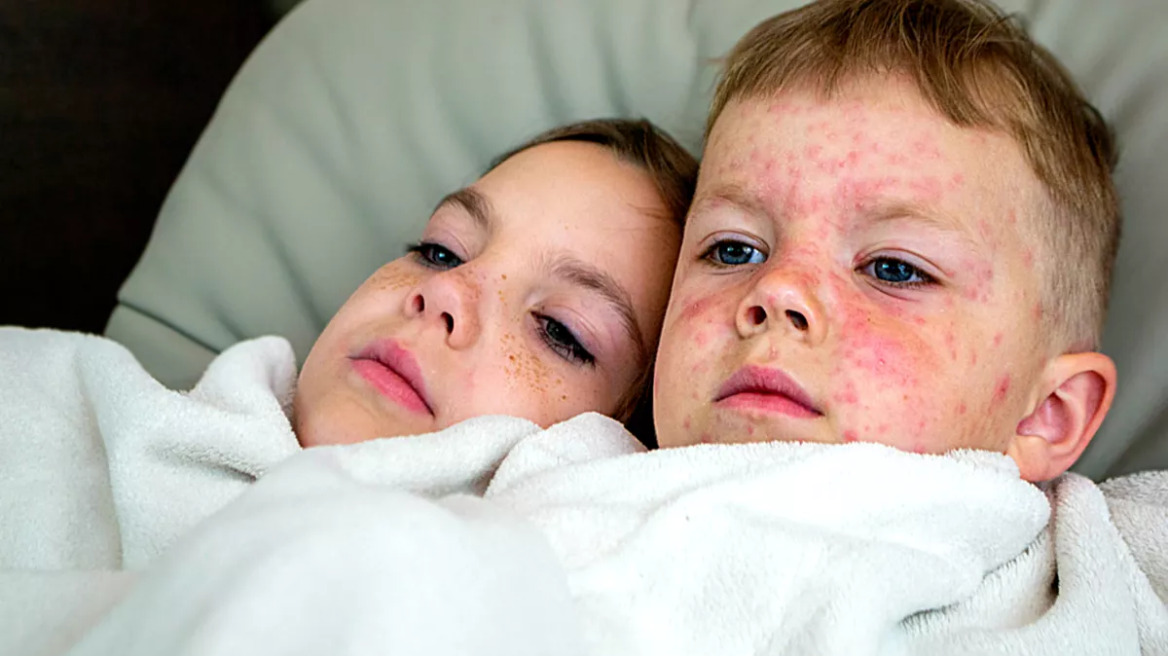 Τι θα συμβεί όταν ένα παιδί με ιλαρά πηγαίνει σχολείο – Το βίντεο του ΠΟΥ απαντά