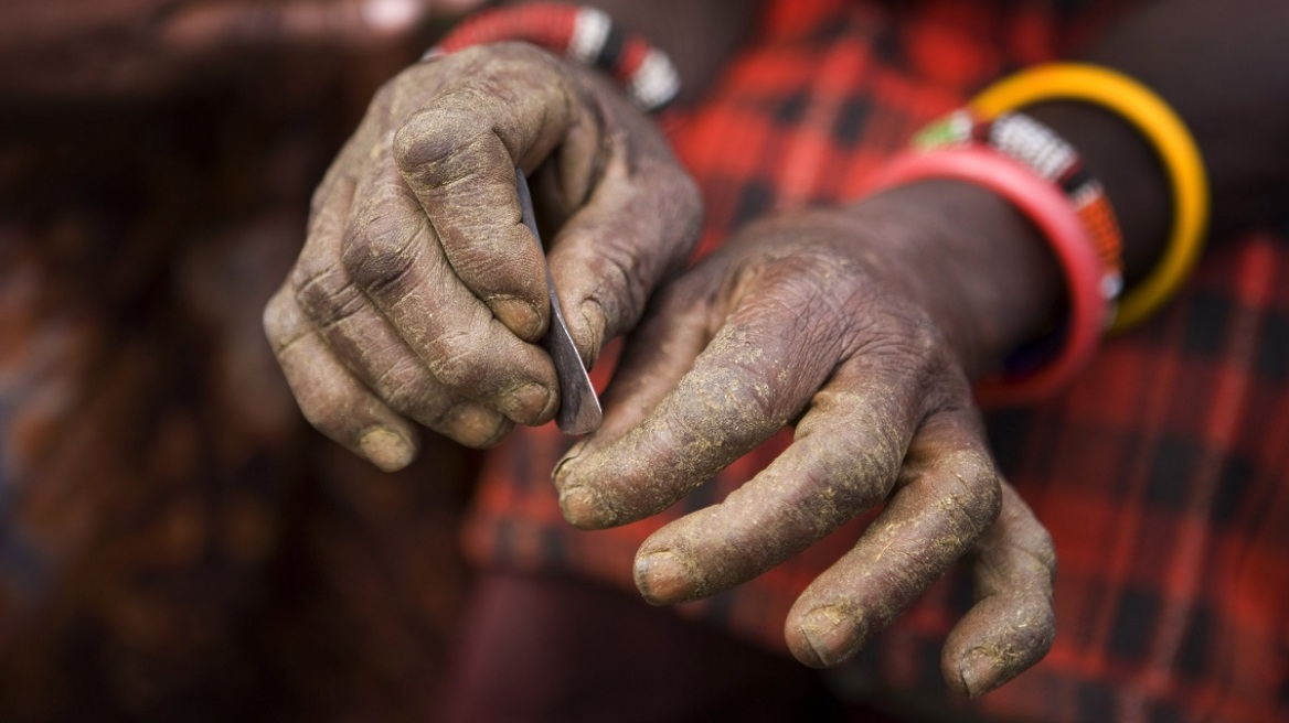 Κάθε χρόνο πάνω από 2 εκατομμύρια κορίτσια υφίστανται ακρωτηριασμό γυναικείων οργάνων