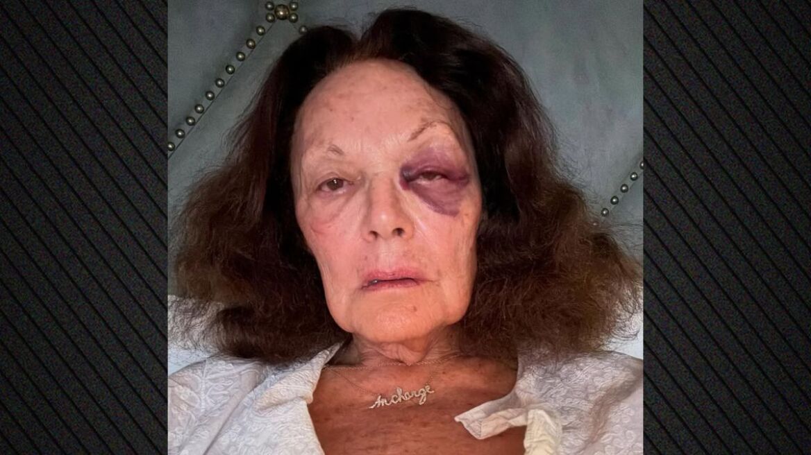 Νταϊάν φον Φίρστενμπεργκ: Με μαυρισμένο μάτι στο Instagram - Ευτυχώς δεν είναι κάτι σοβαρό, έγραψε