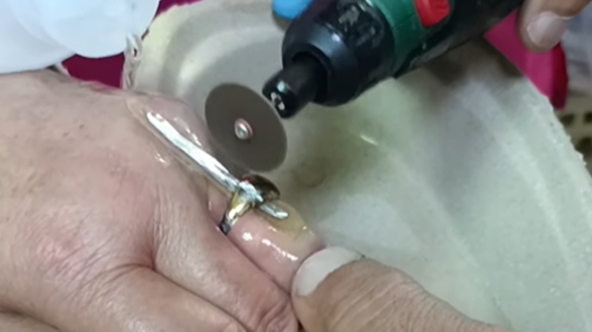 Βόλος: Μάχη γιατρών με ατσάλινο δαχτυλίδι στο Νοσοκομείο - Δείτε βίντεο