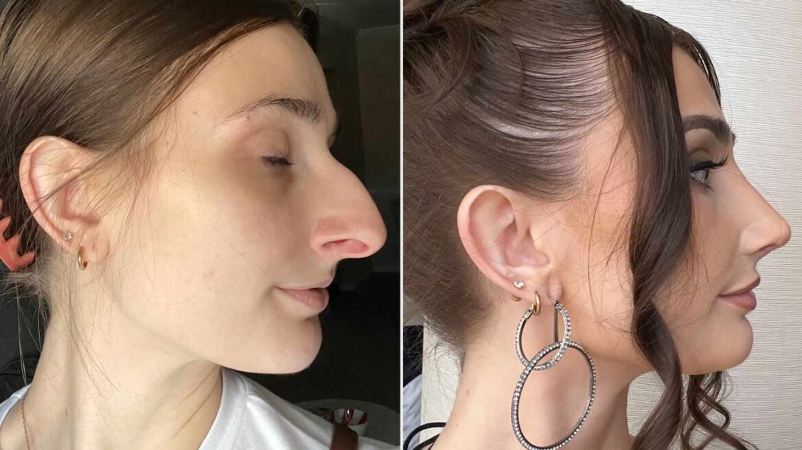 «Μετά την πλαστική μύτης που έκανα μπόρεσα να σκεφτώ αρκετά καθαρά ώστε να πάρω διαζύγιο»