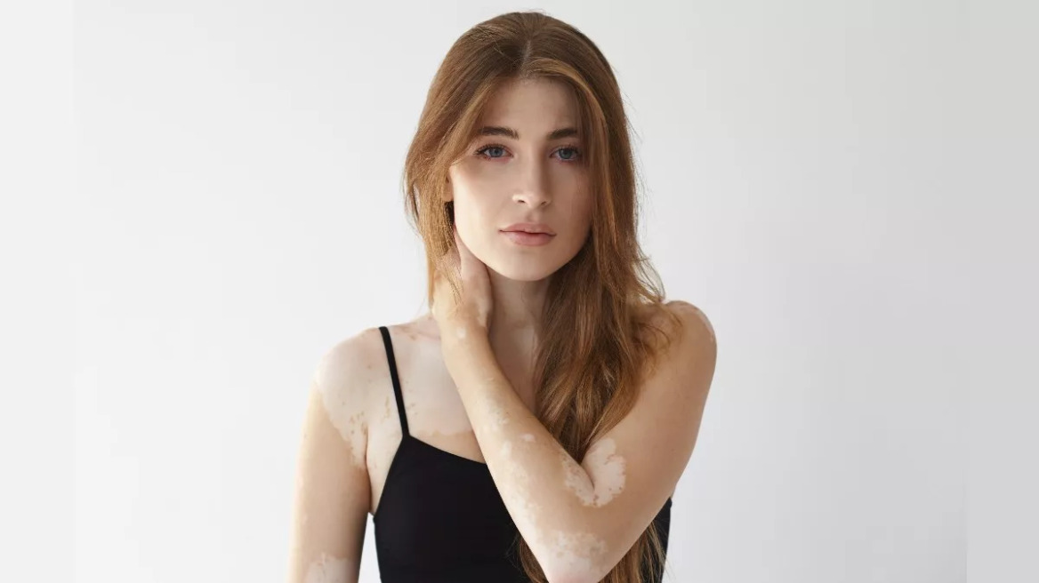 Γιατί τα αυτοάνοσα «προτιμούν» τις γυναίκες; Δεν είναι μόνο η γενετική – Ο ανεξερεύνητος παράγοντας