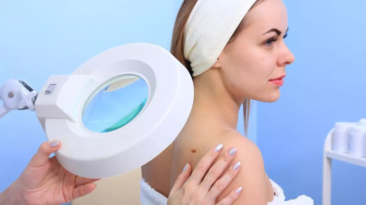 Μελάνωμα: Δωρεάν δερματολογικές εξετάσεις – Δείτε σε ποιες πόλεις