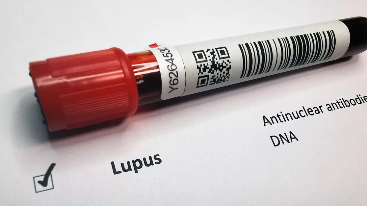 Συστηματικός Ερυθηματώδης Λύκος: Πρόκληση η ζωή με την αυτοάνοση νόσο