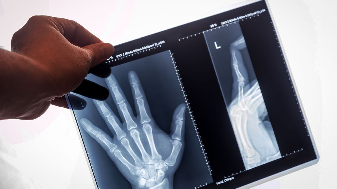 H περίεργη θεωρία για ανθρώπους που «δεν έχουν σπάσει ποτέ κόκαλο»