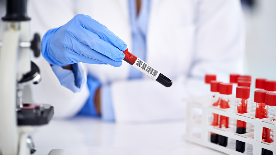 ΗΠΑ: Πράσινο φως για το πρώτο τεστ διάγνωσης του Αλτσχάιμερ με μια απλή εξέταση αίματος
